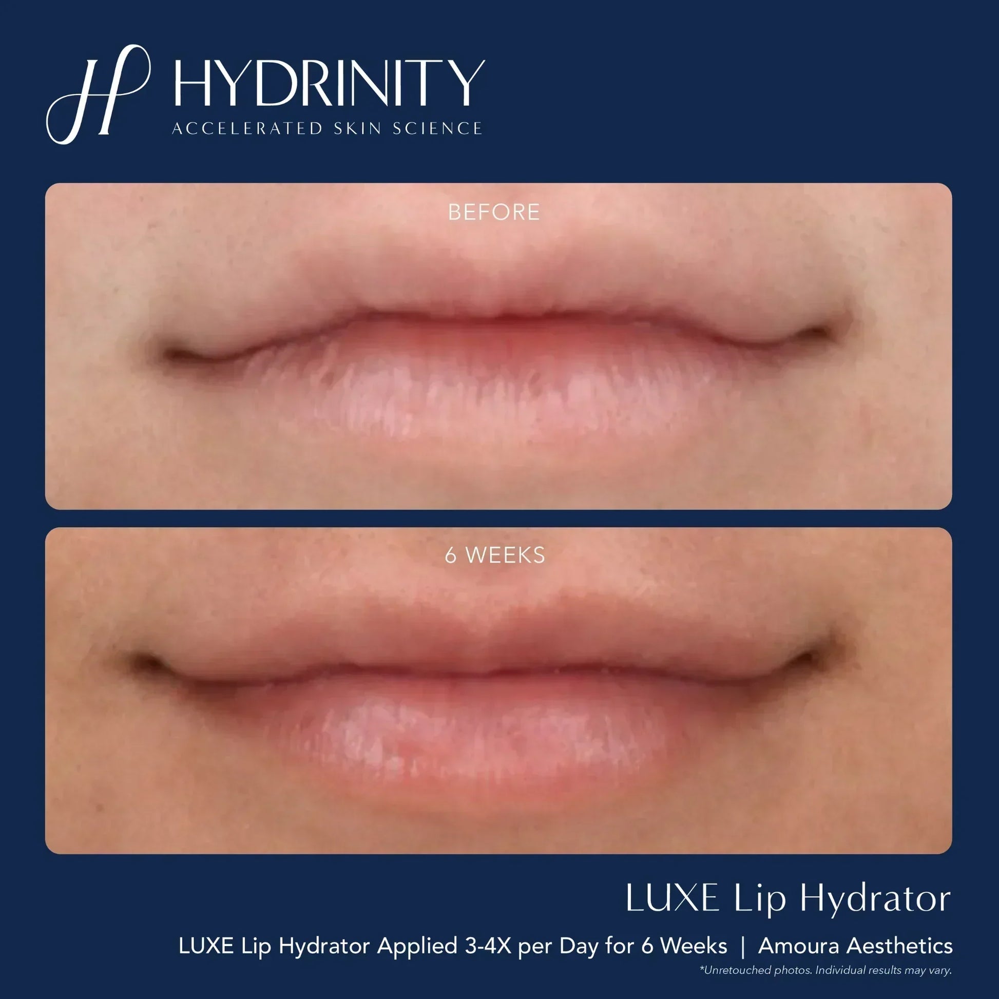 Hydrinity LUXE Lip Hydrator for Ultimate Moisture
