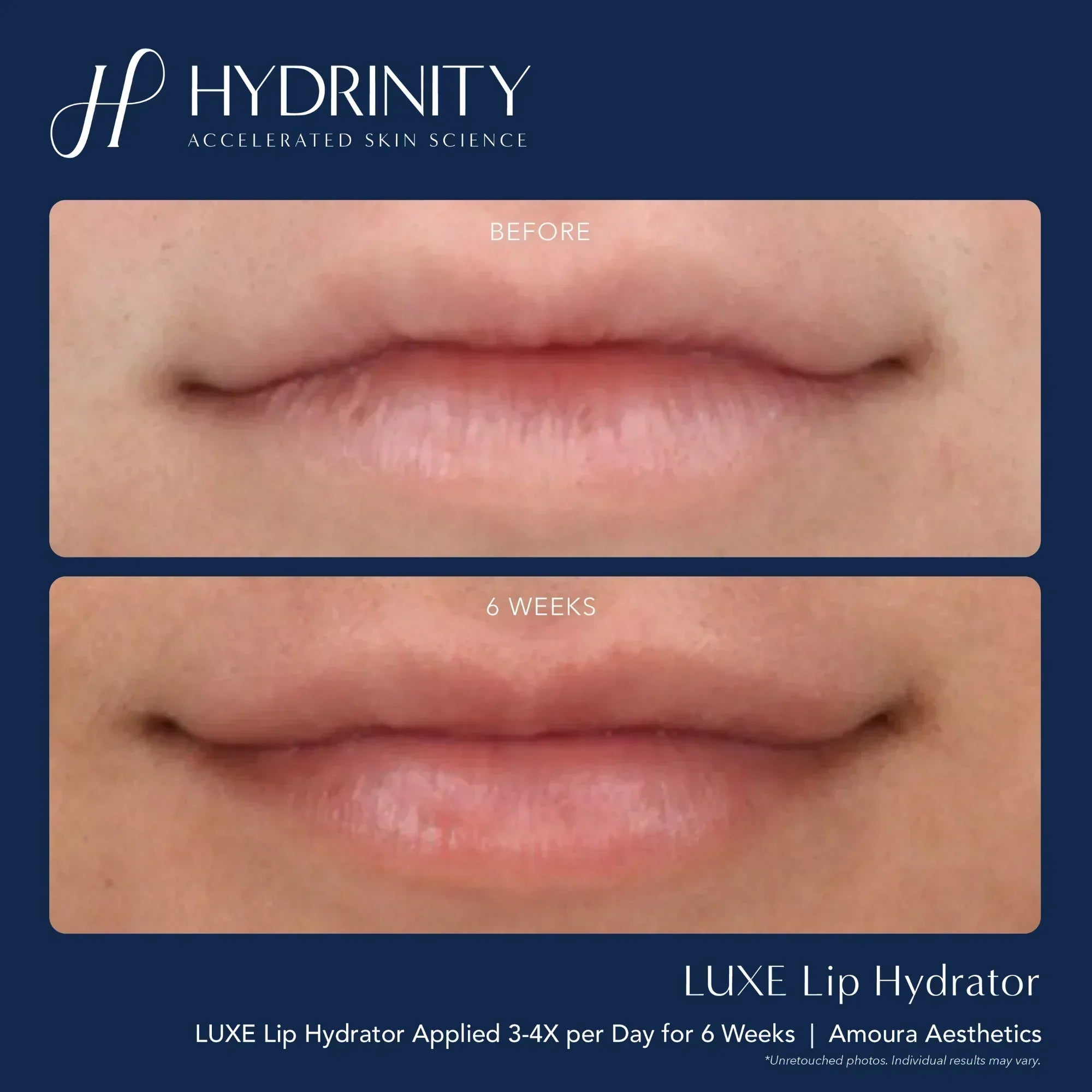 Hydrinity LUXE Lip Hydrator for Ultimate Moisture