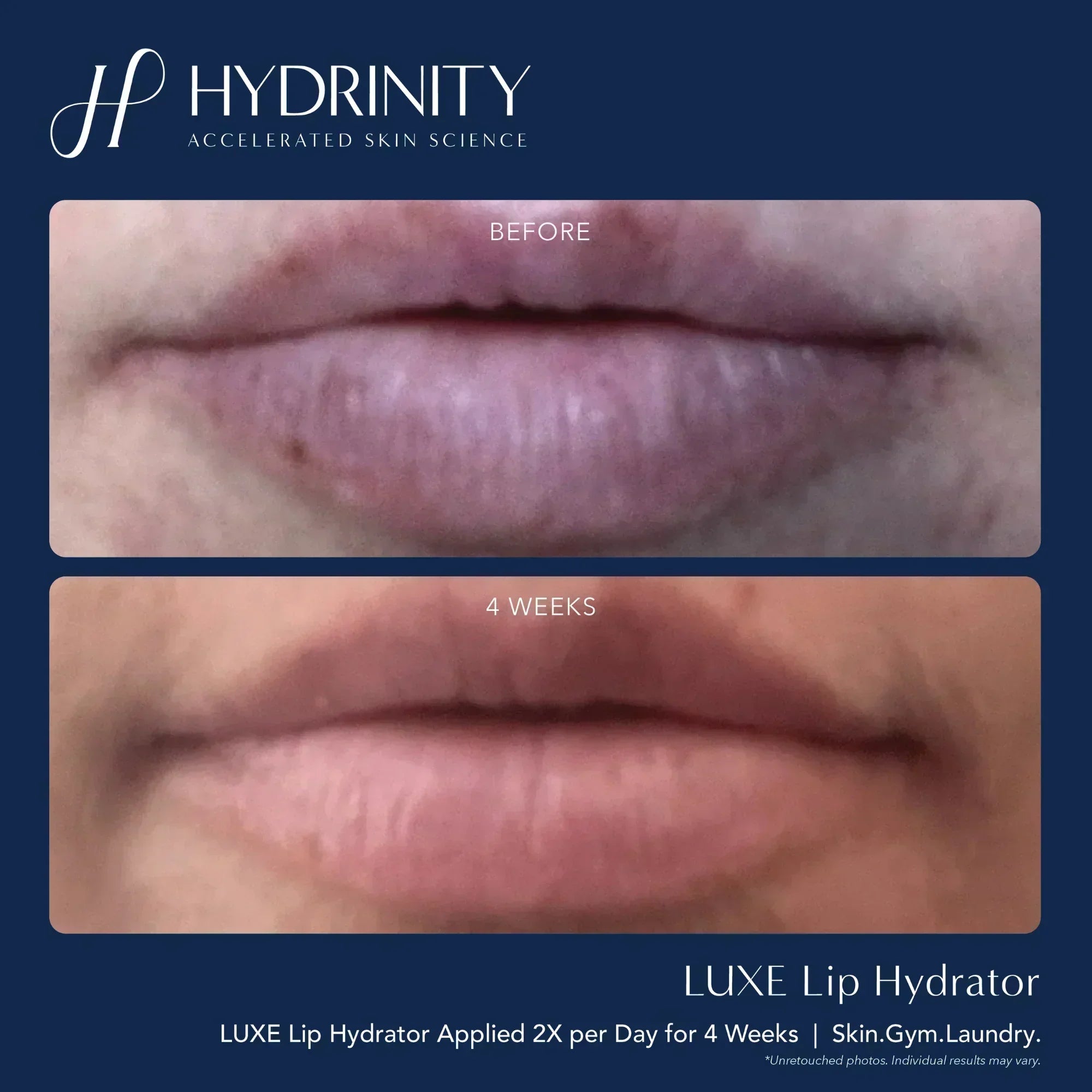 Hydrinity LUXE Lip Hydrator for Ultimate Moisture