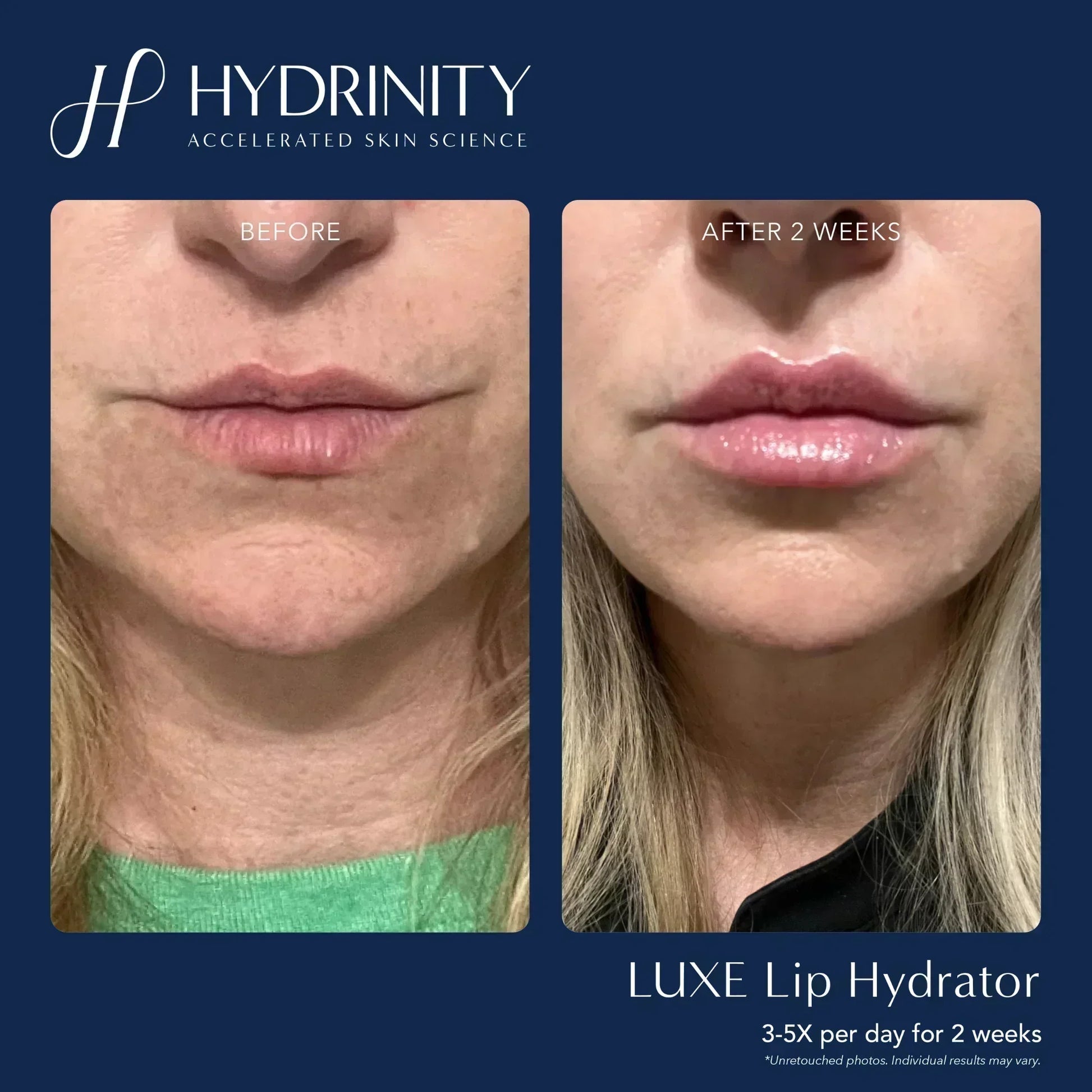 Hydrinity LUXE Lip Hydrator for Ultimate Moisture