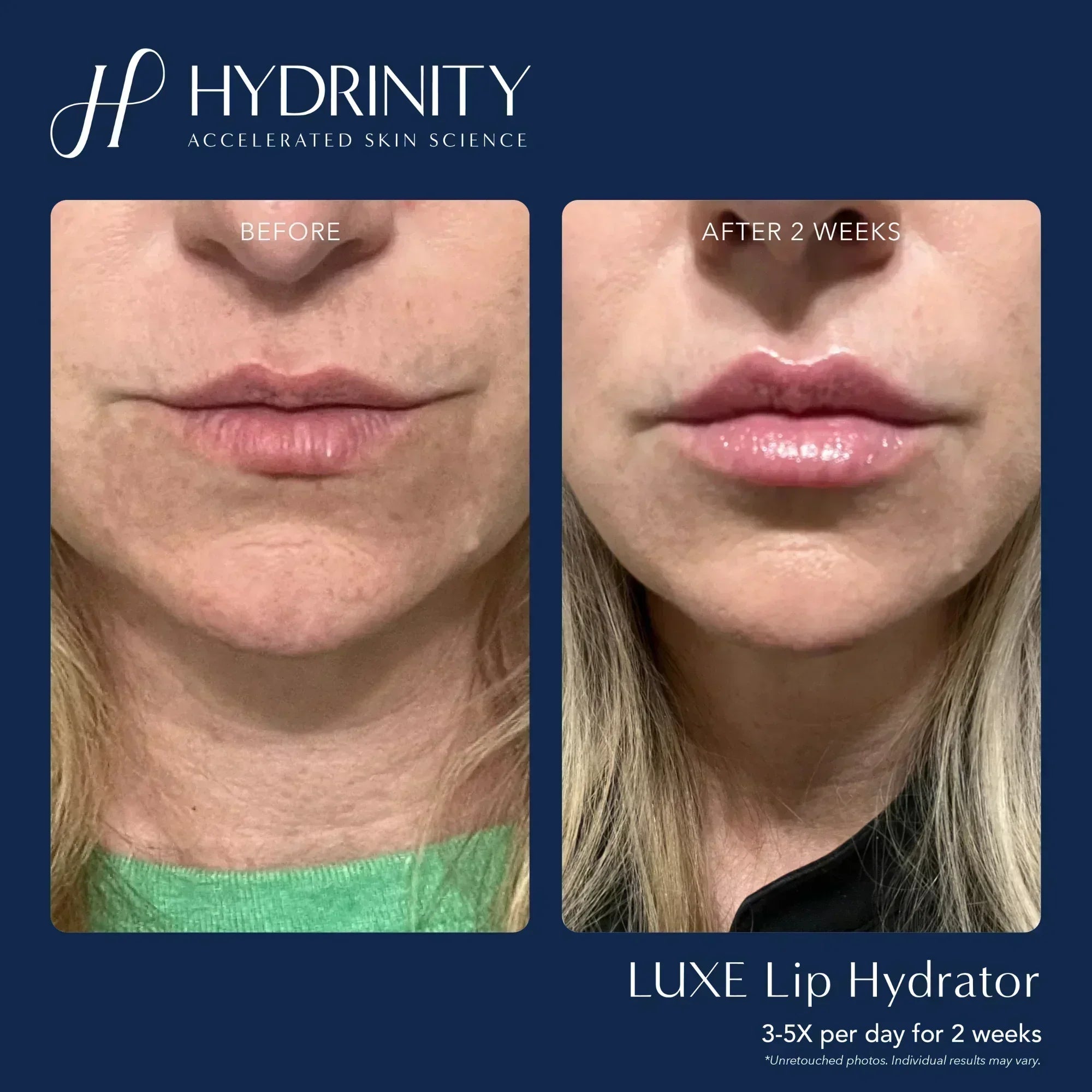 Hydrinity LUXE Lip Hydrator for Ultimate Moisture