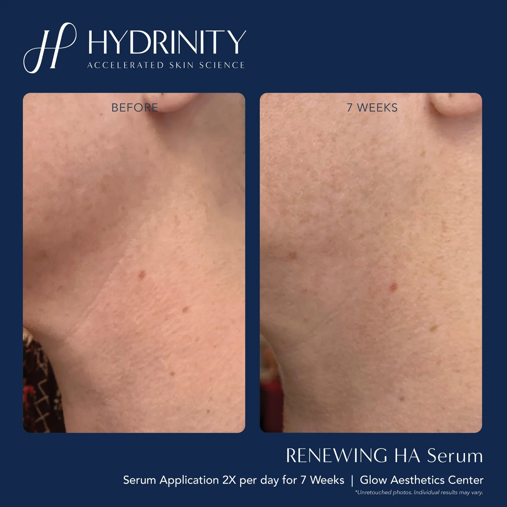 Renewing HA Serum - MariposaSkincare.com