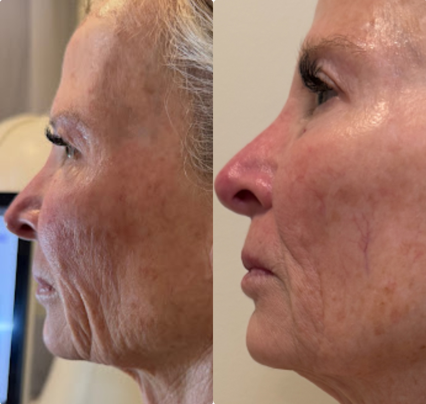 Mariposa Aesthetics & Laser Center T-Shape Facial Contouring Device