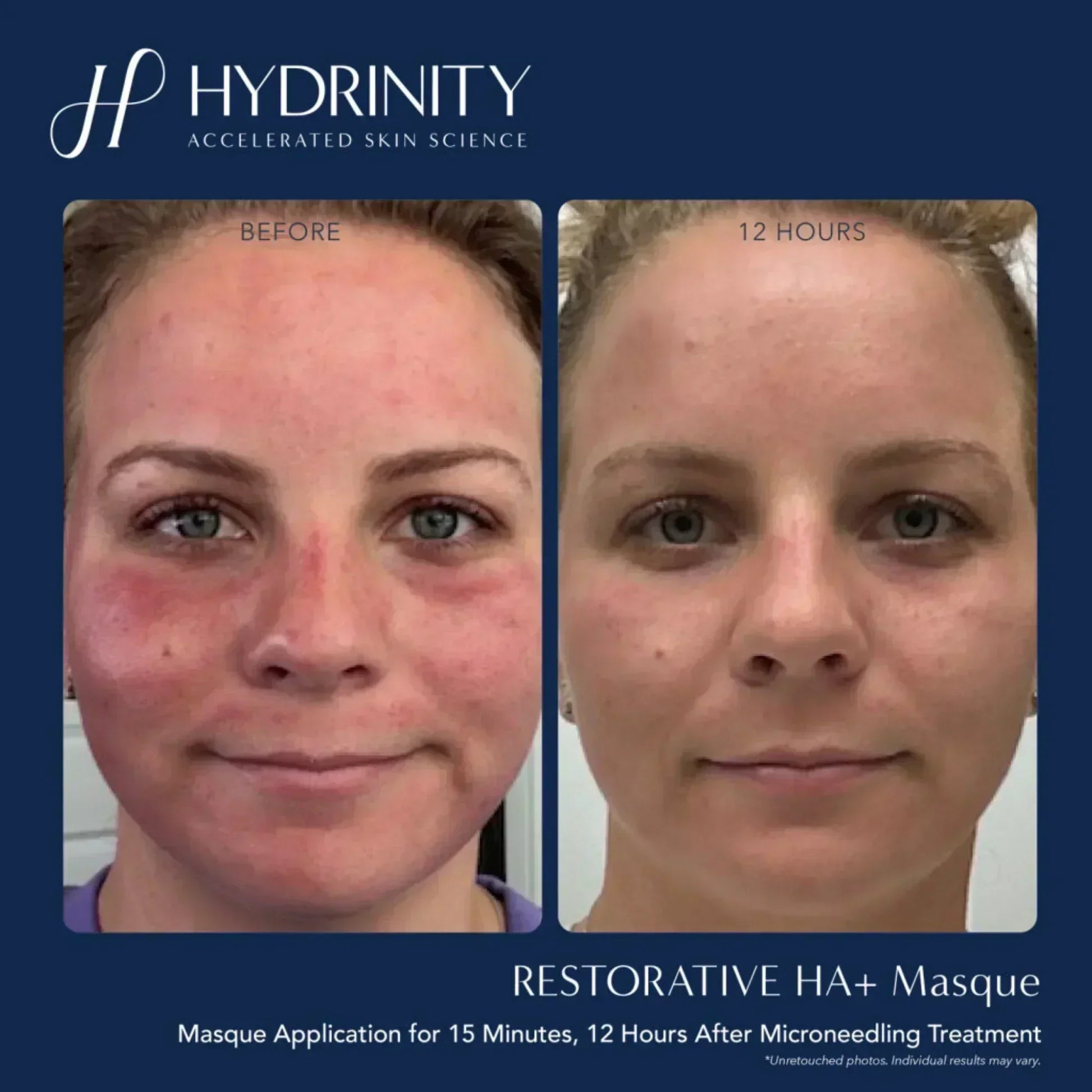 Hydrinity Restorative HA+ Masque - Hydrating Facial Sheet Mask
