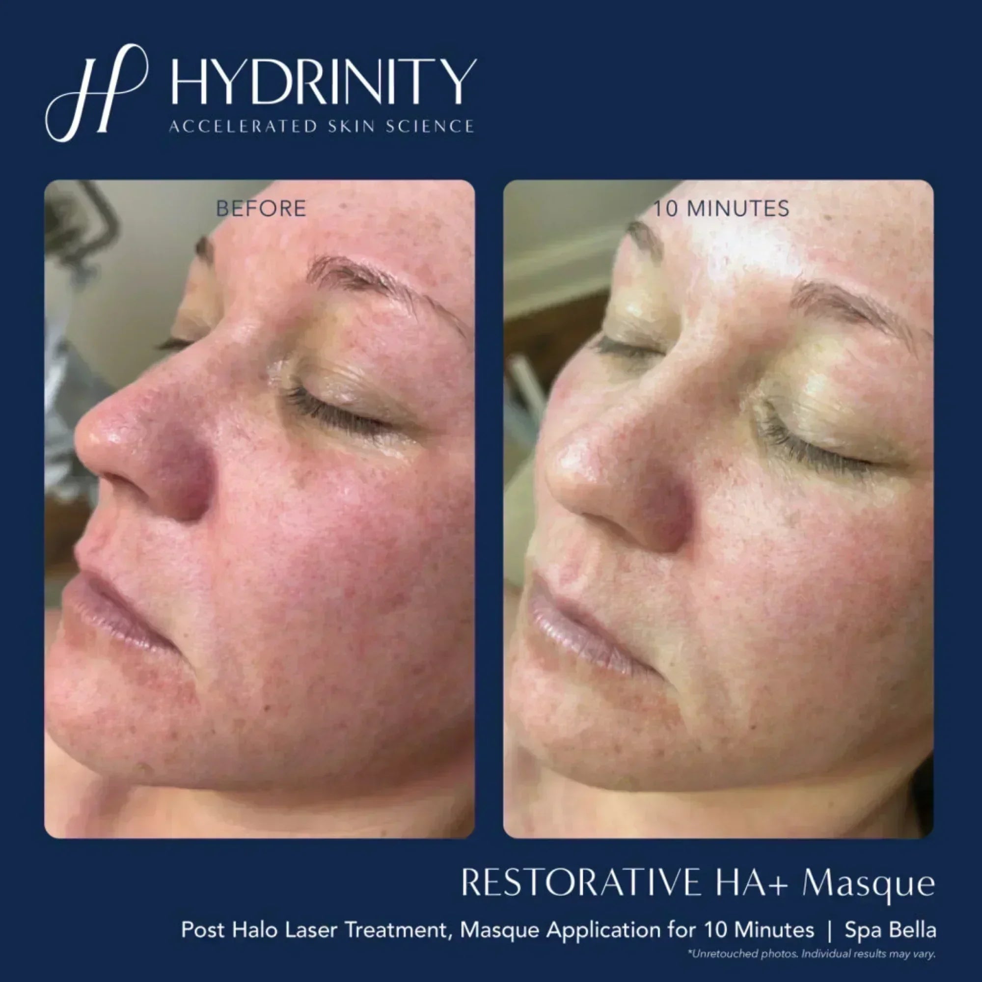 Hydrinity Restorative HA+ Masque - Hydrating Facial Sheet Mask
