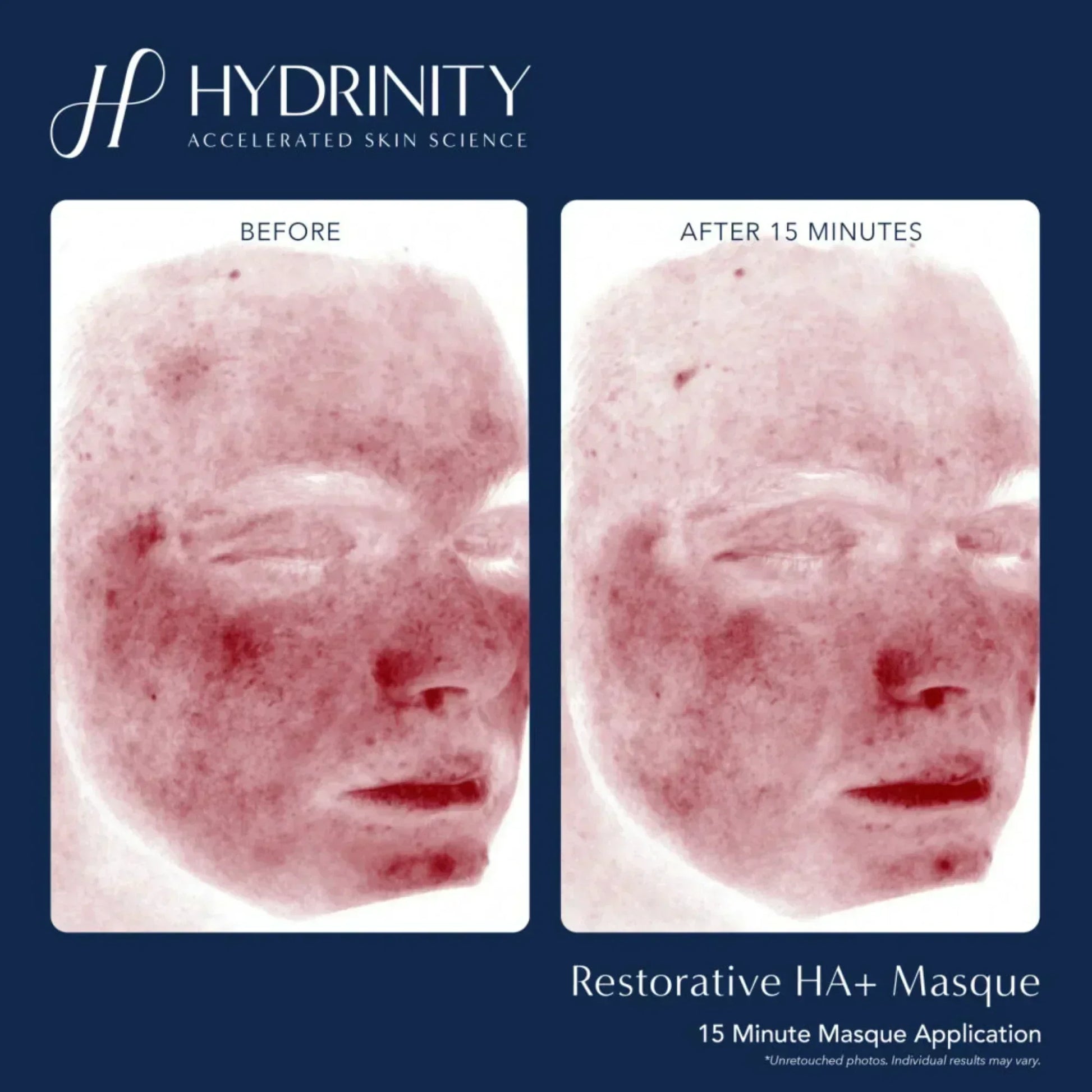 Hydrinity Restorative HA+ Masque - Hydrating Facial Sheet Mask