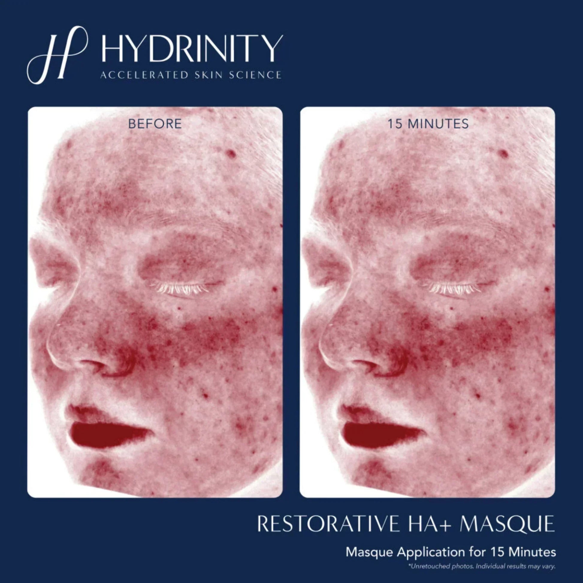 Hydrinity Restorative HA+ Masque - Hydrating Facial Sheet Mask
