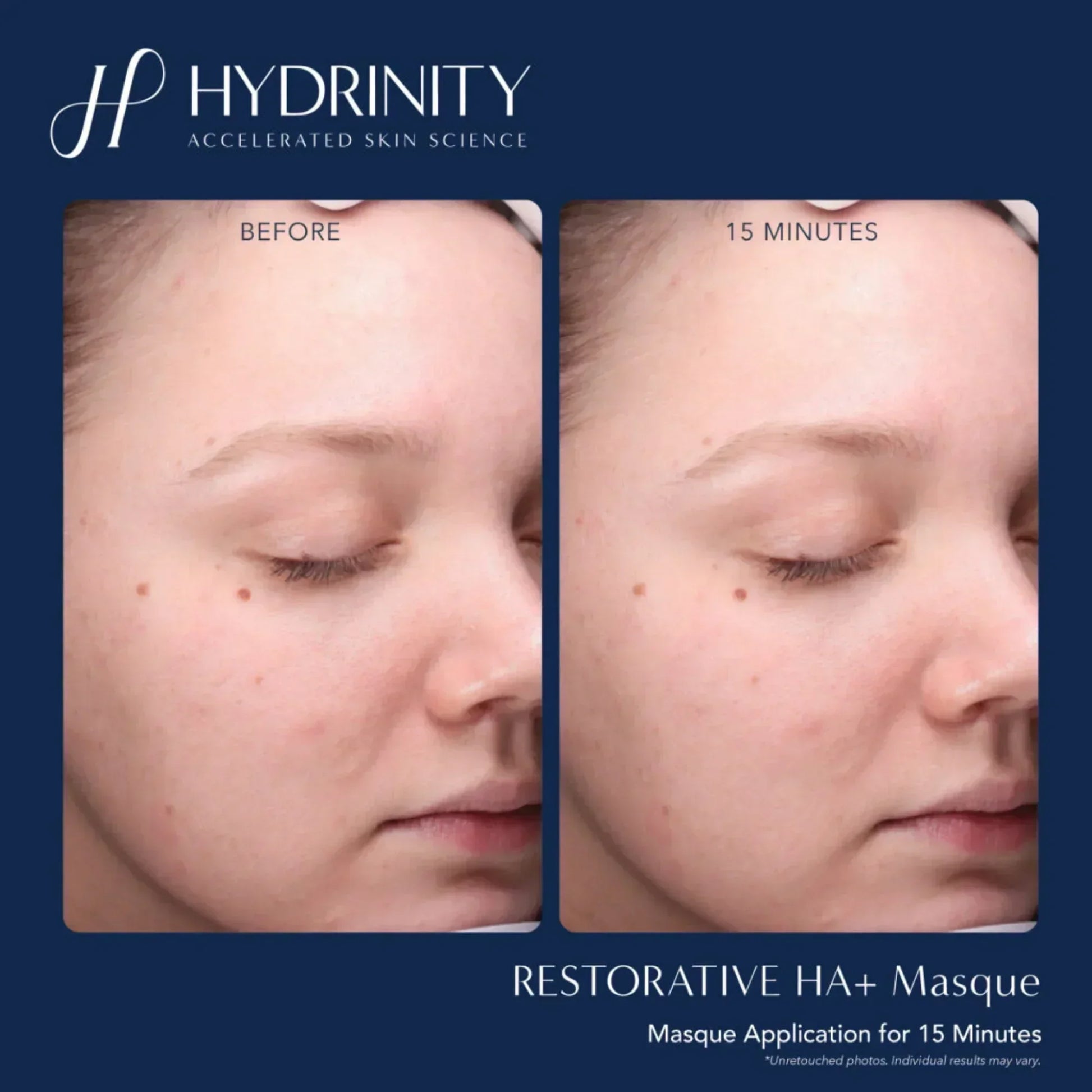 Hydrinity Restorative HA+ Masque - Hydrating Facial Sheet Mask