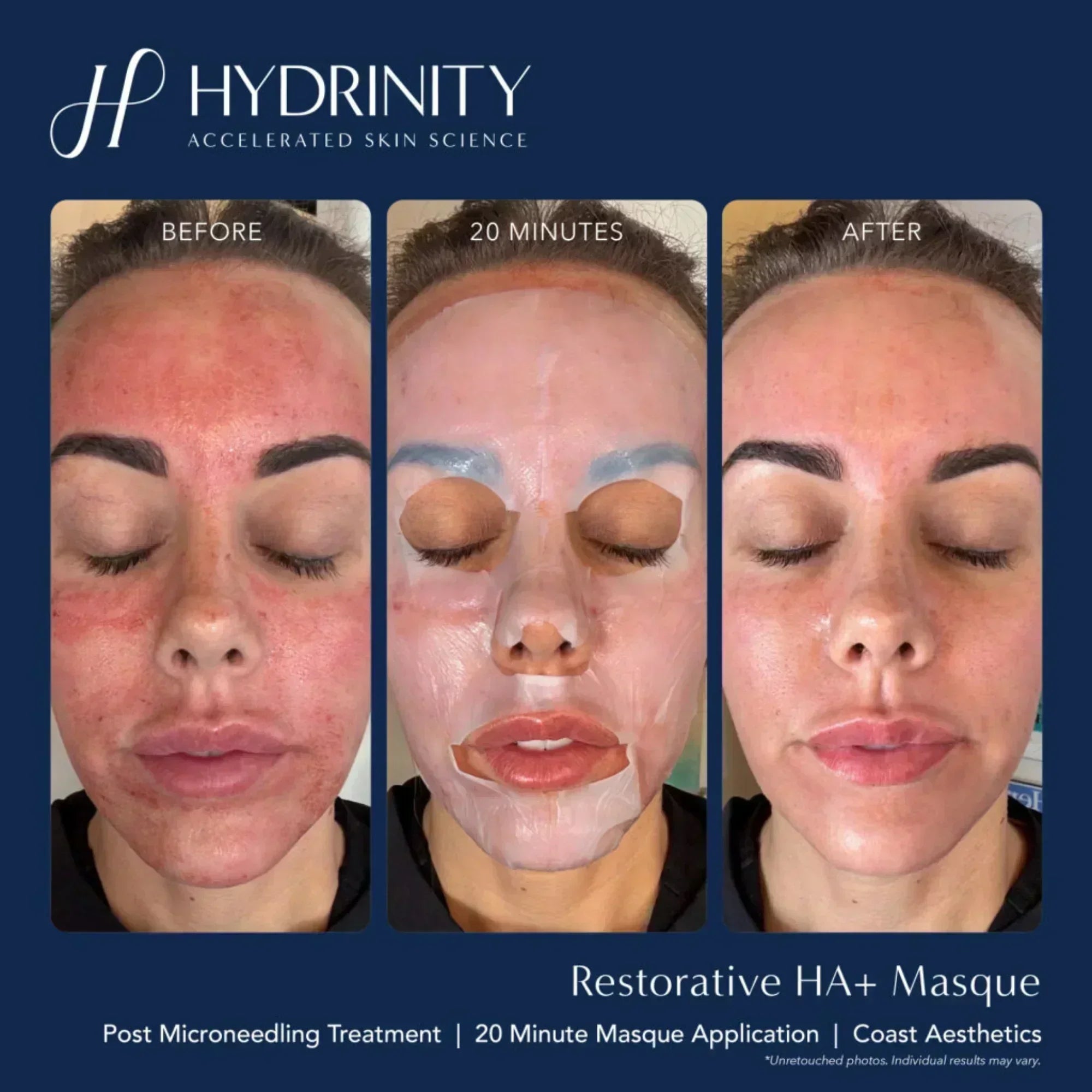 Hydrinity Restorative HA+ Masque - Hydrating Facial Sheet Mask