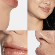 Mariposa Aesthetics & Laser Center Purchase Dermal Fillers Online