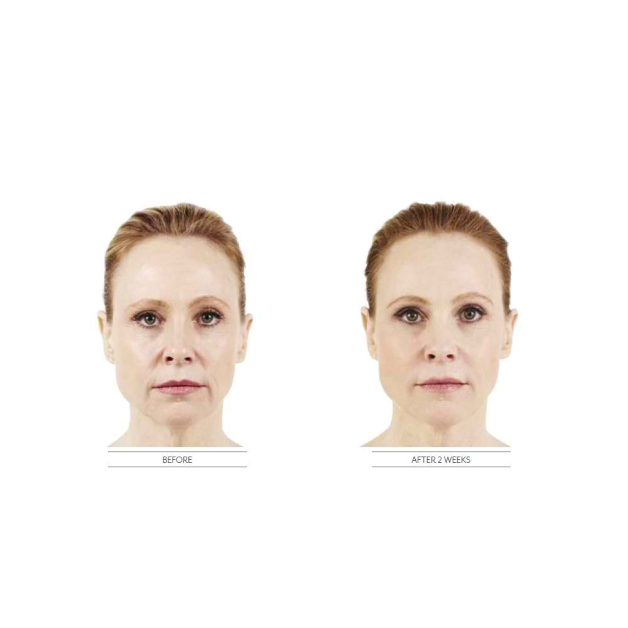 Mariposa Aesthetics & Laser Center Purchase Dermal Fillers Online