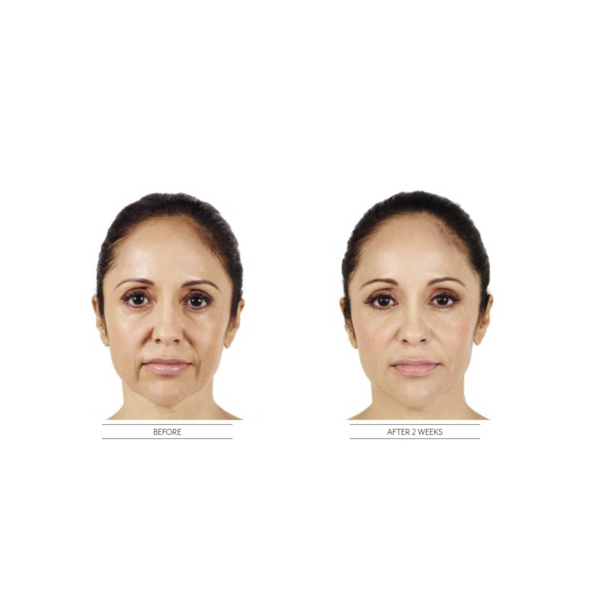 Mariposa Aesthetics & Laser Center Purchase Dermal Fillers Online