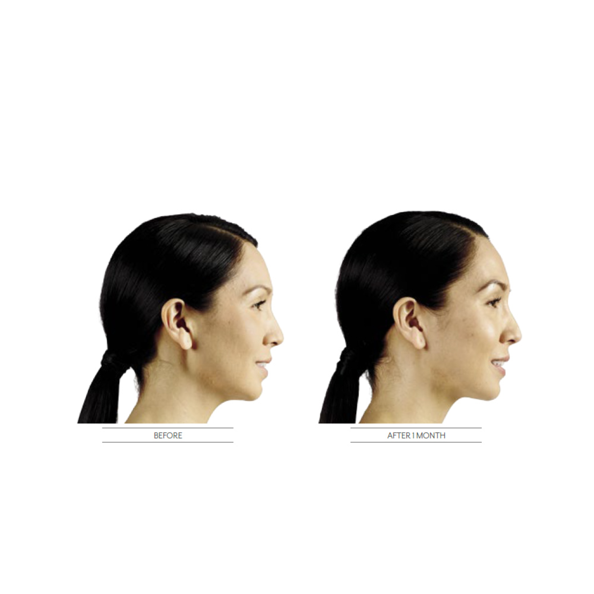 Mariposa Aesthetics & Laser Center Purchase Dermal Fillers Online