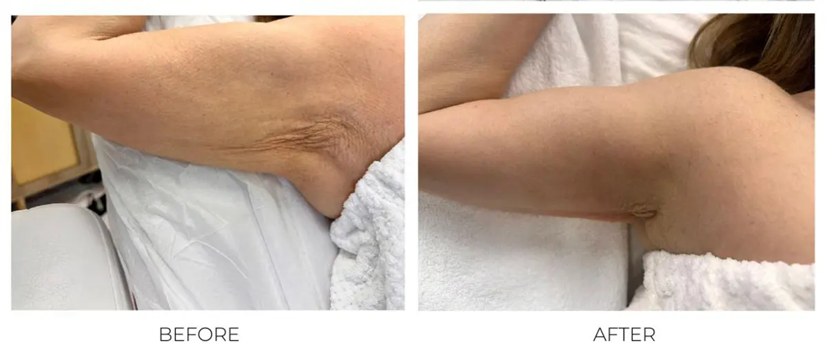 Mariposa Aesthetics & Laser Center T-Shape Body Contouring Device