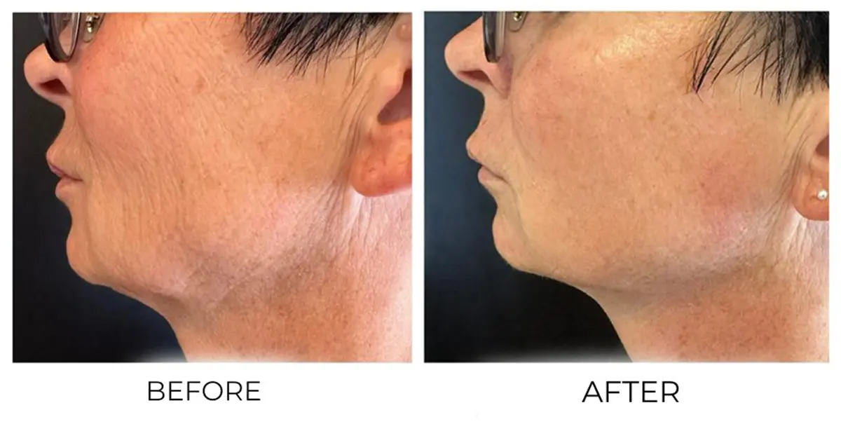 Mariposa Aesthetics & Laser Center T-Shape Facial Contouring Device