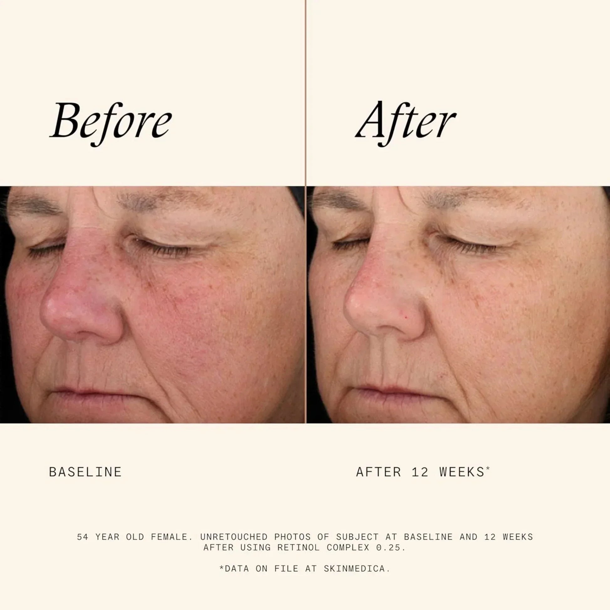 SkinMedica® Retinol Complex 0.25 Skincare Solution