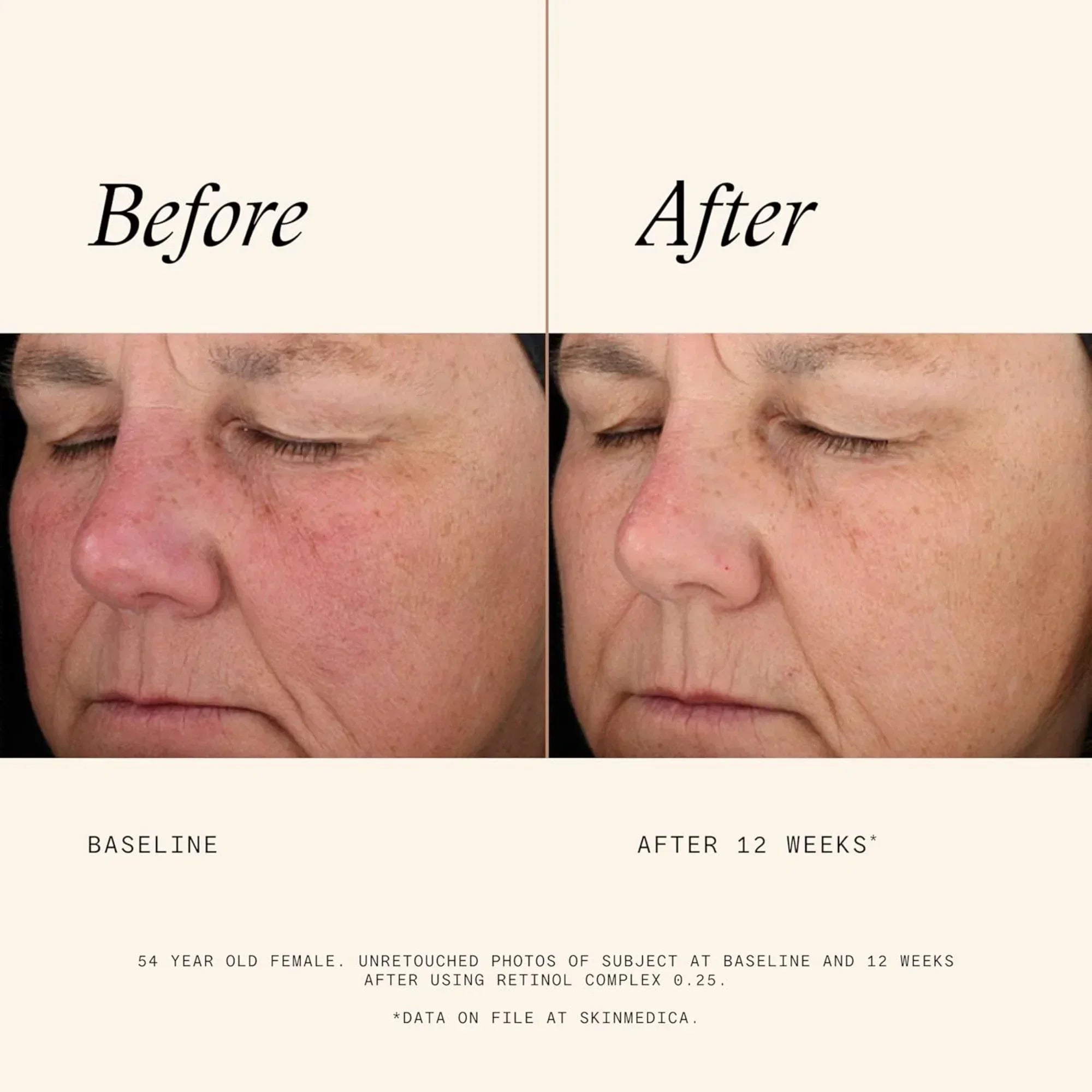 SkinMedica® Retinol Complex 0.25 Skincare Solution