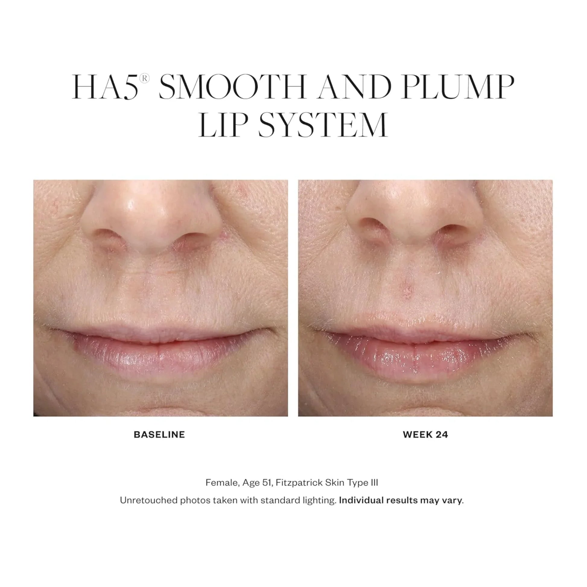 HA⁵® Smooth and Plump Lip System - MariposaSkincare.com