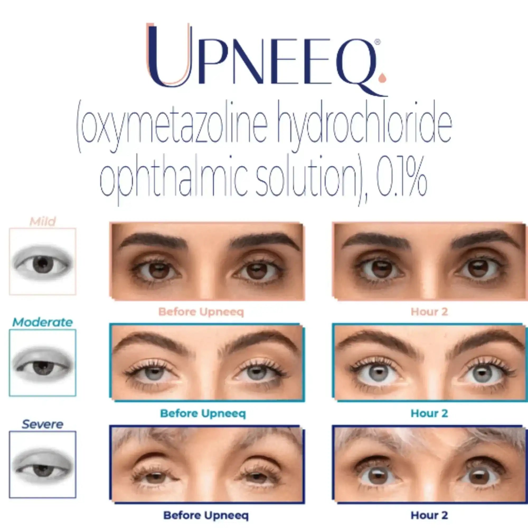 Upneeq eye drop results for mild, moderate, and severe eyelid droop before and after 2 hours.
