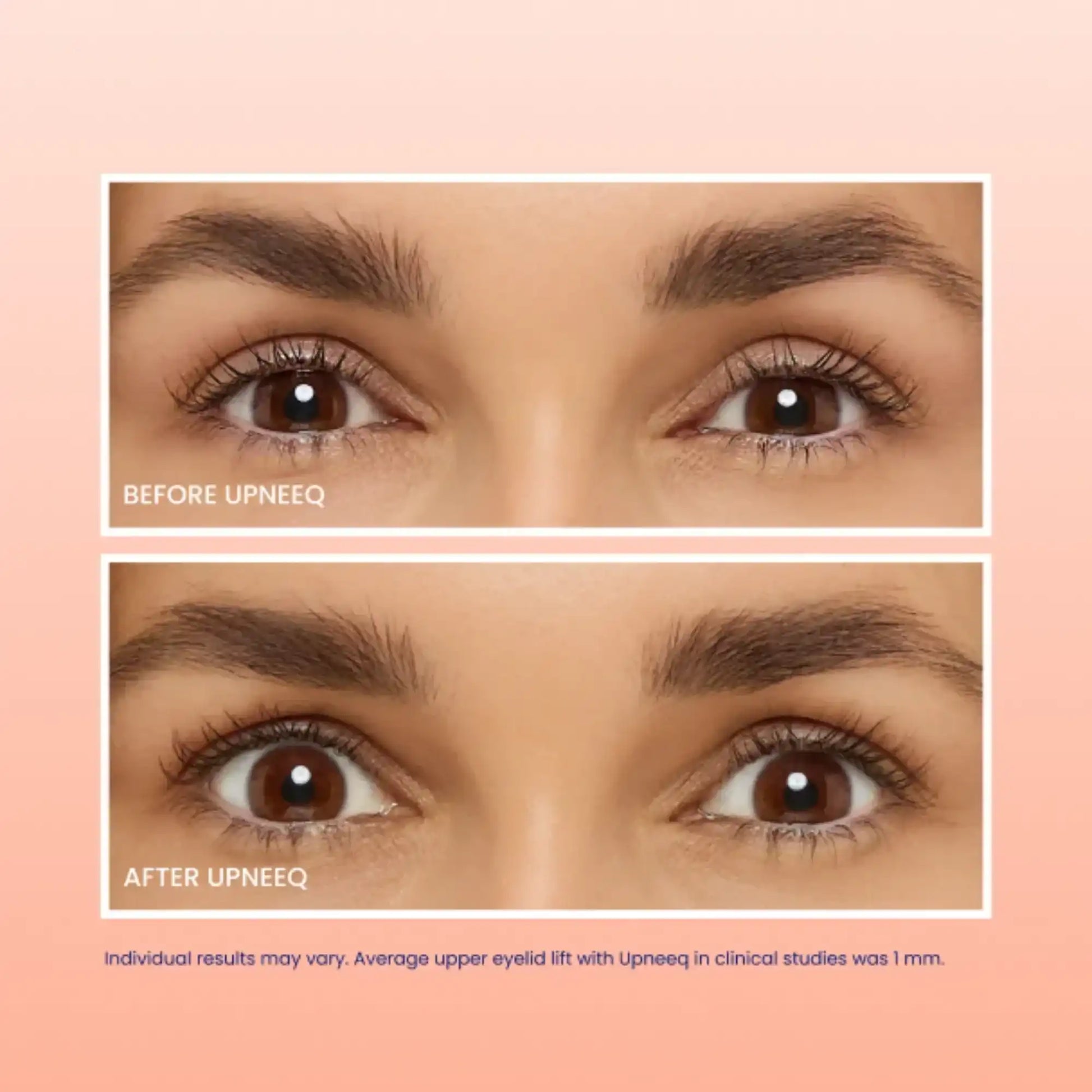 Close-up before and after photo showing visible eyelid lift results from Upneeq treatment.
