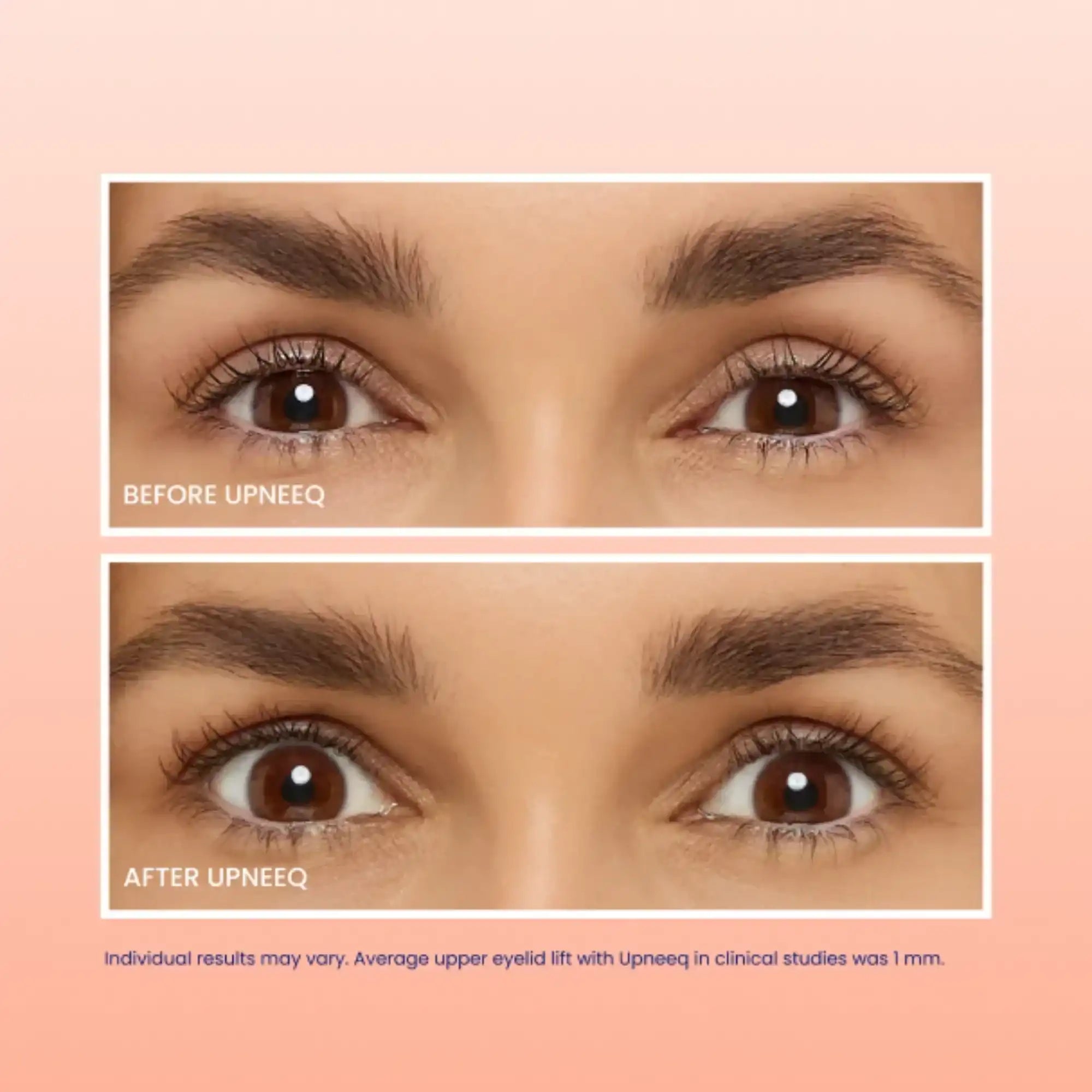 Close-up before and after photo showing visible eyelid lift results from Upneeq treatment.