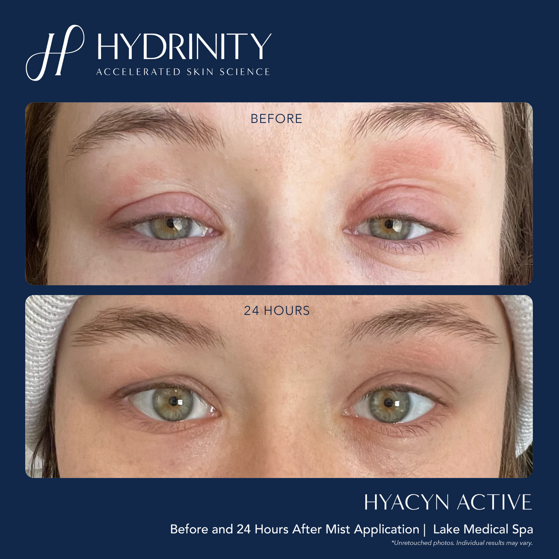 HYACYN ACTIVE - MariposaSkincare.com