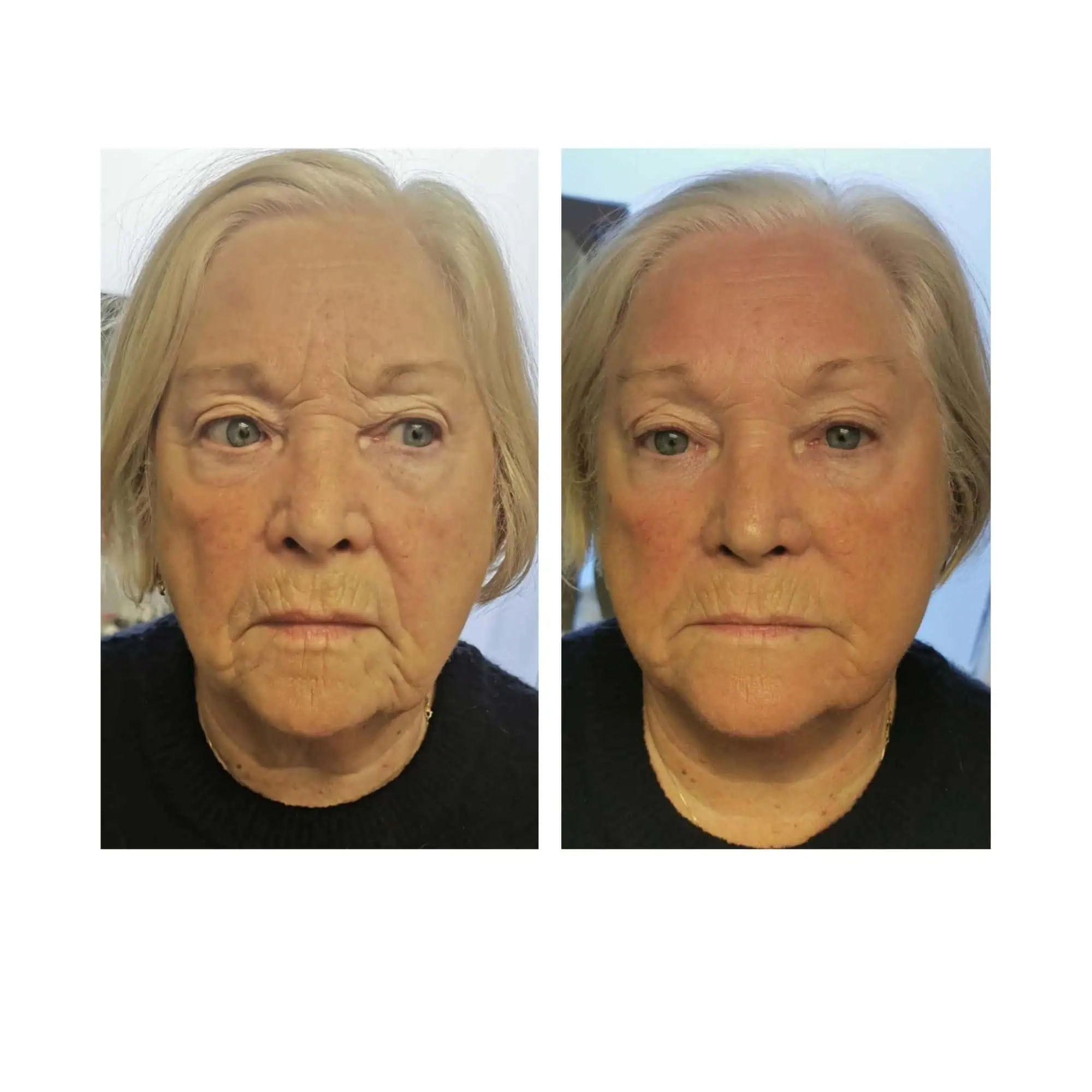 Mariposa Aesthetics & Laser Center T-Shape Facial Contouring Device