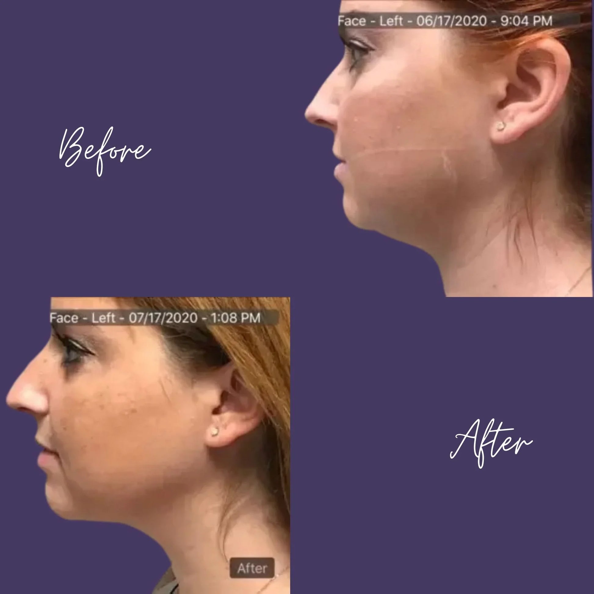 Agnes Precision RF Microneedling