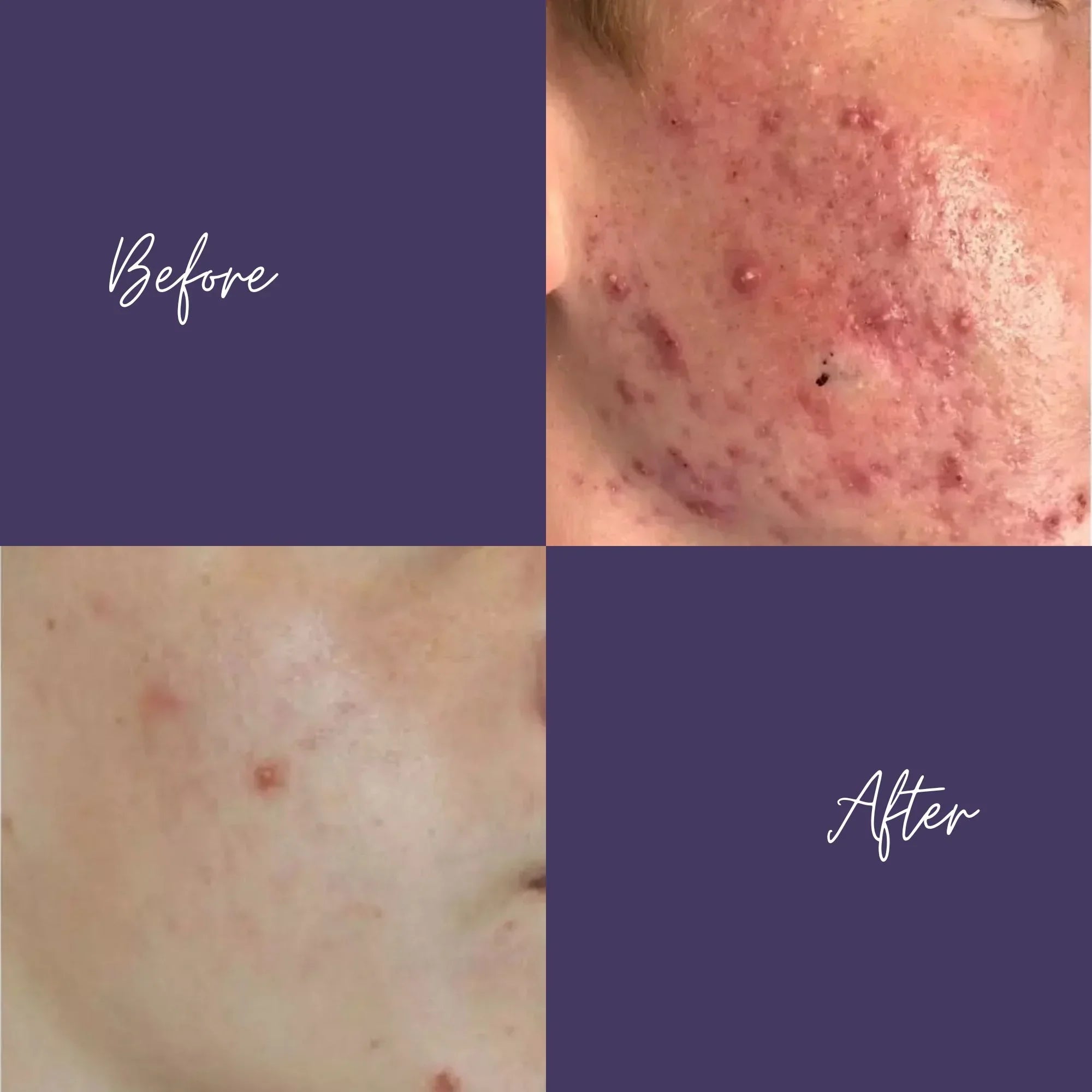 Agnes Precision RF Microneedling