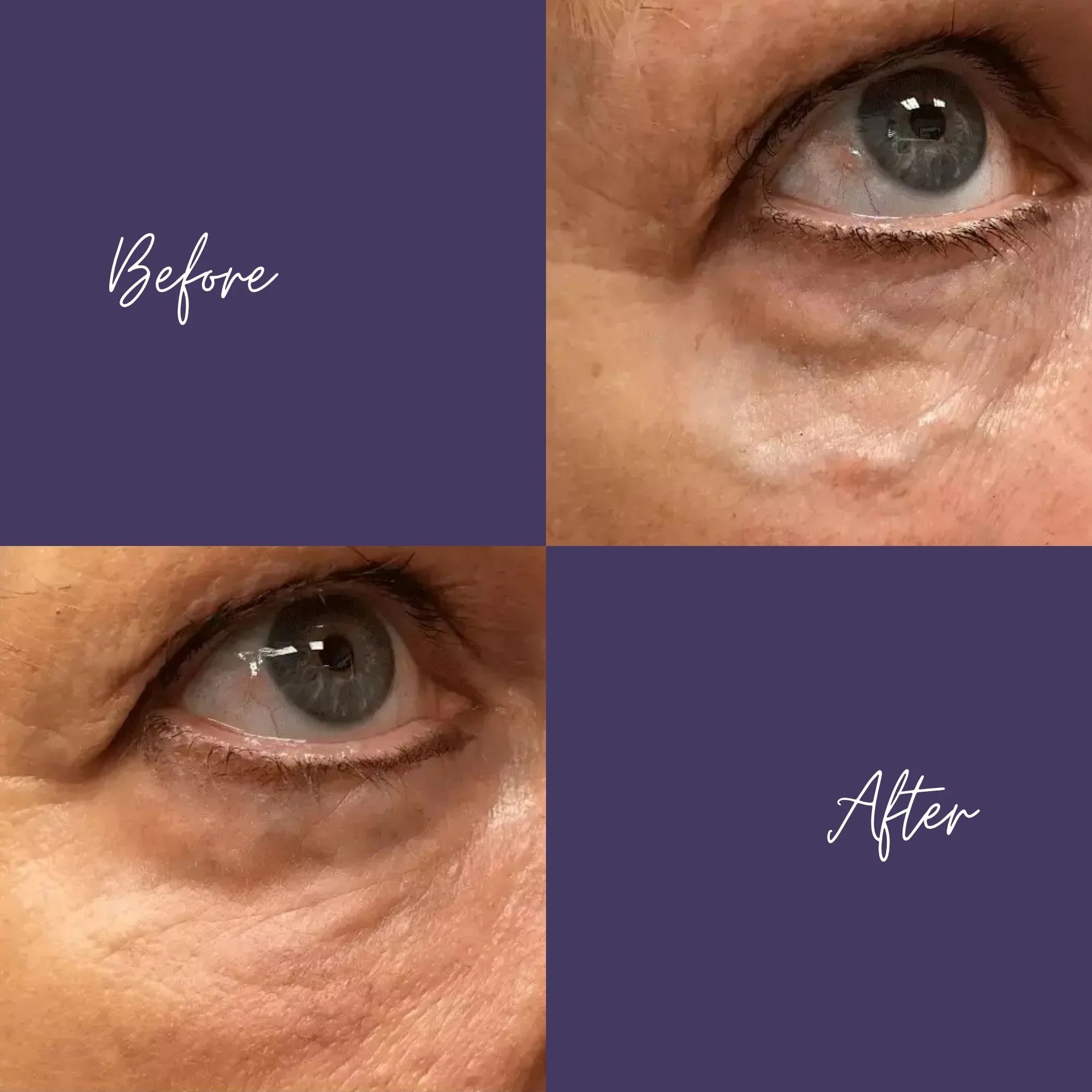 Agnes Precision RF Microneedling