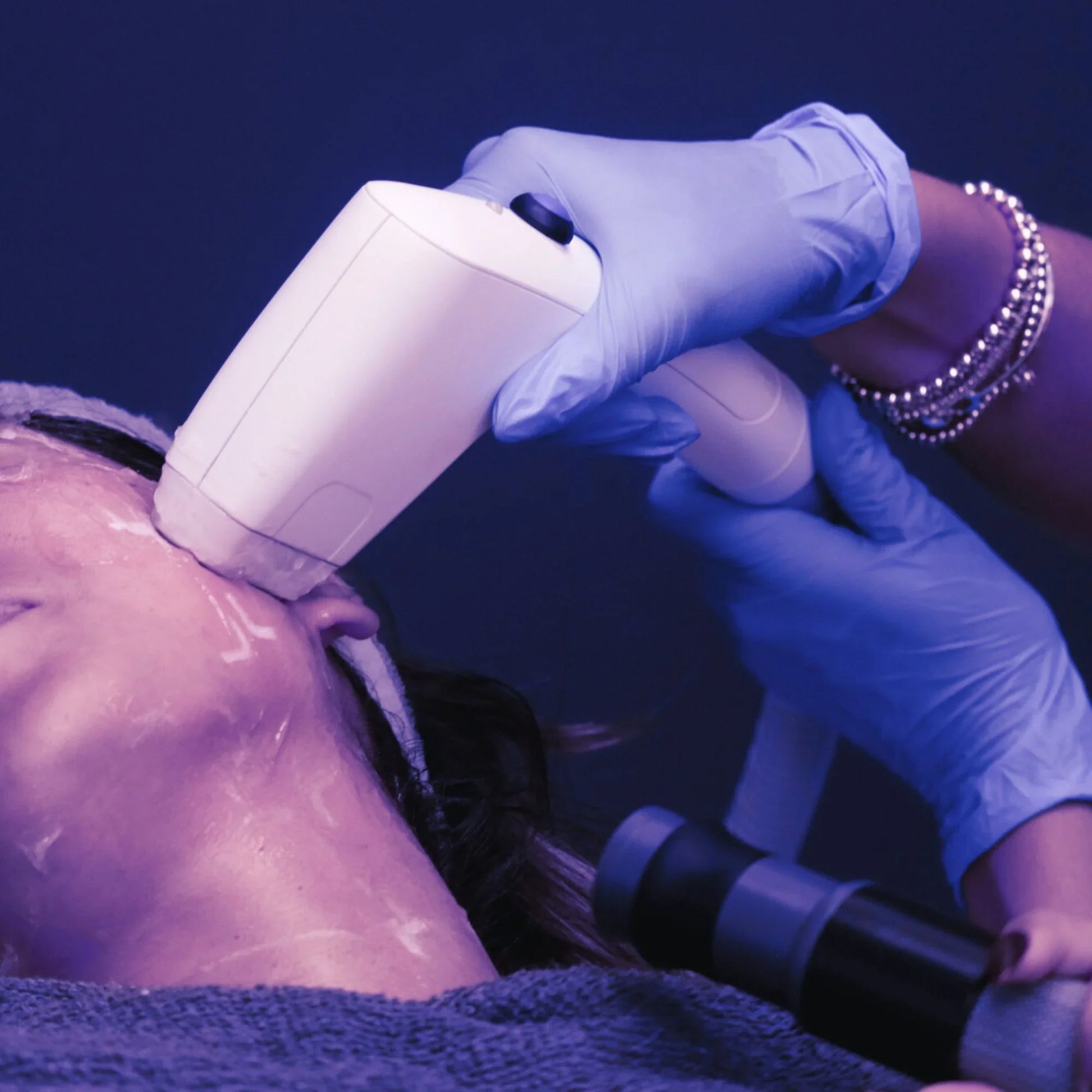 CO2 Laser Resurfacing + Free Secret RF Neck & Hands (Feb 1-28)