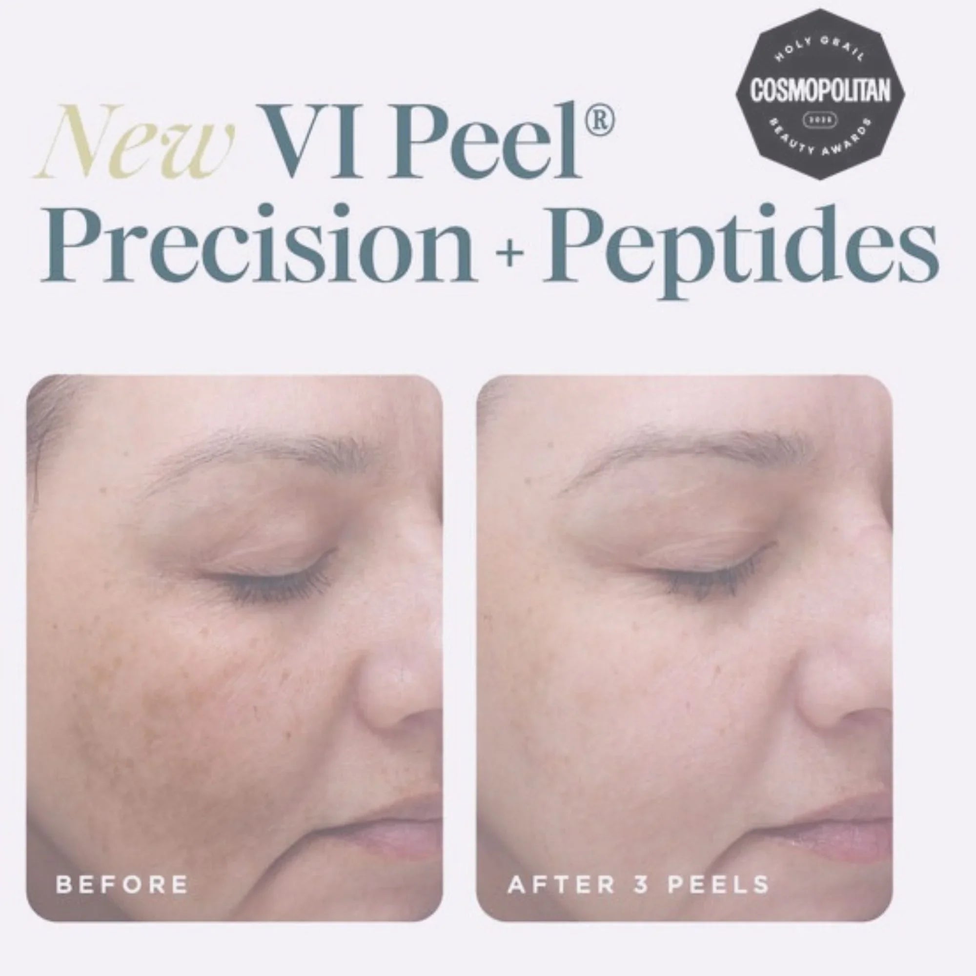 VI Peel Precision Plus: Chemical Peels: Receive Free Neck Treatment (Feb 1-28)