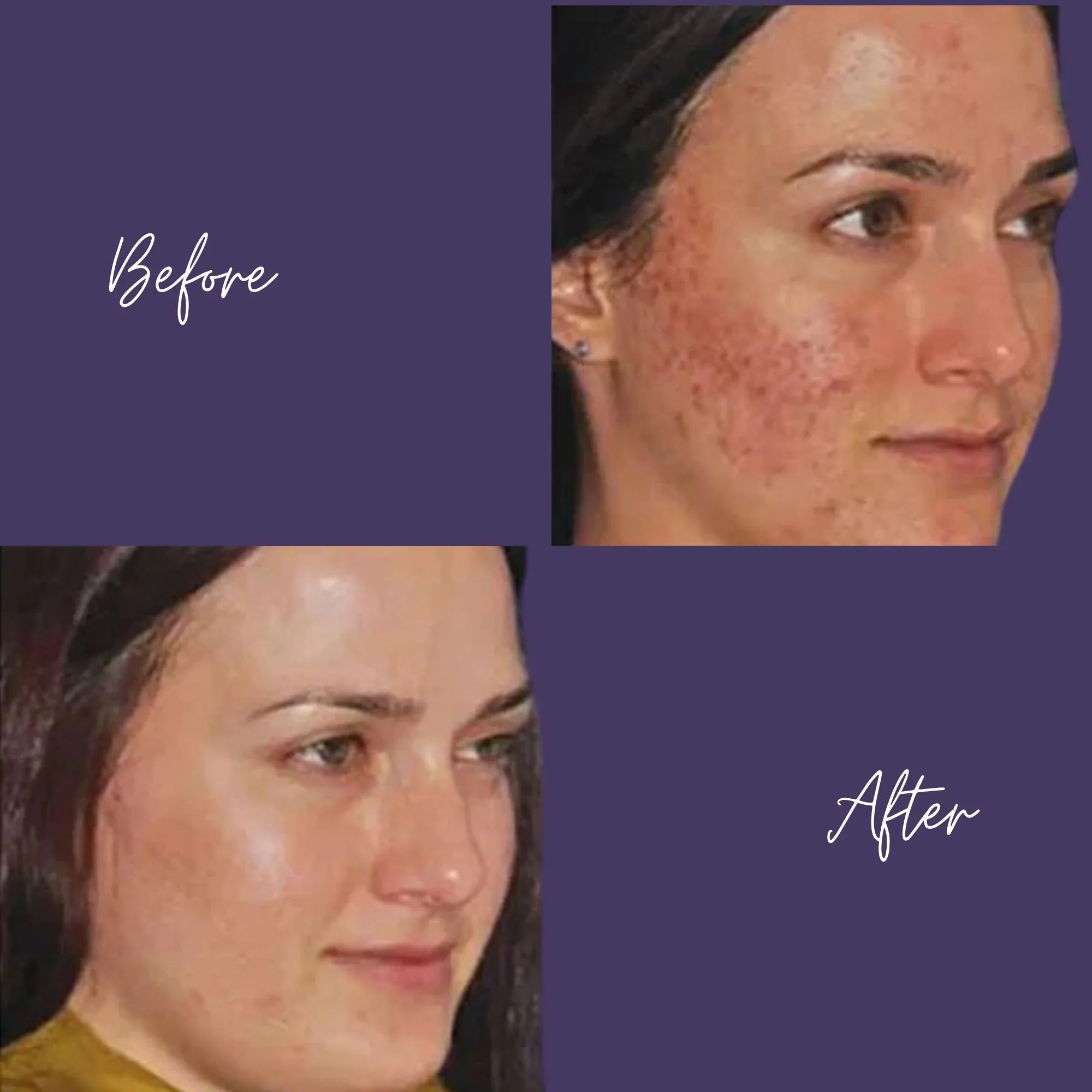 Eclipse MicroPen Microneedling with PRP Rejuvenation Therapy