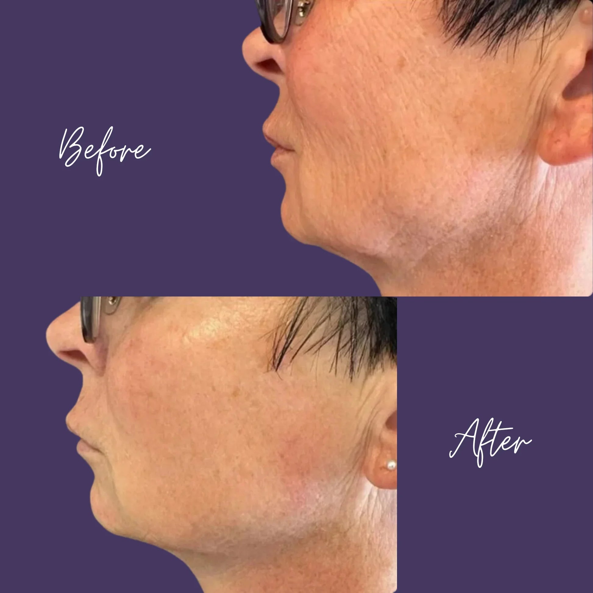 T-Shape 2 Facial Contouring