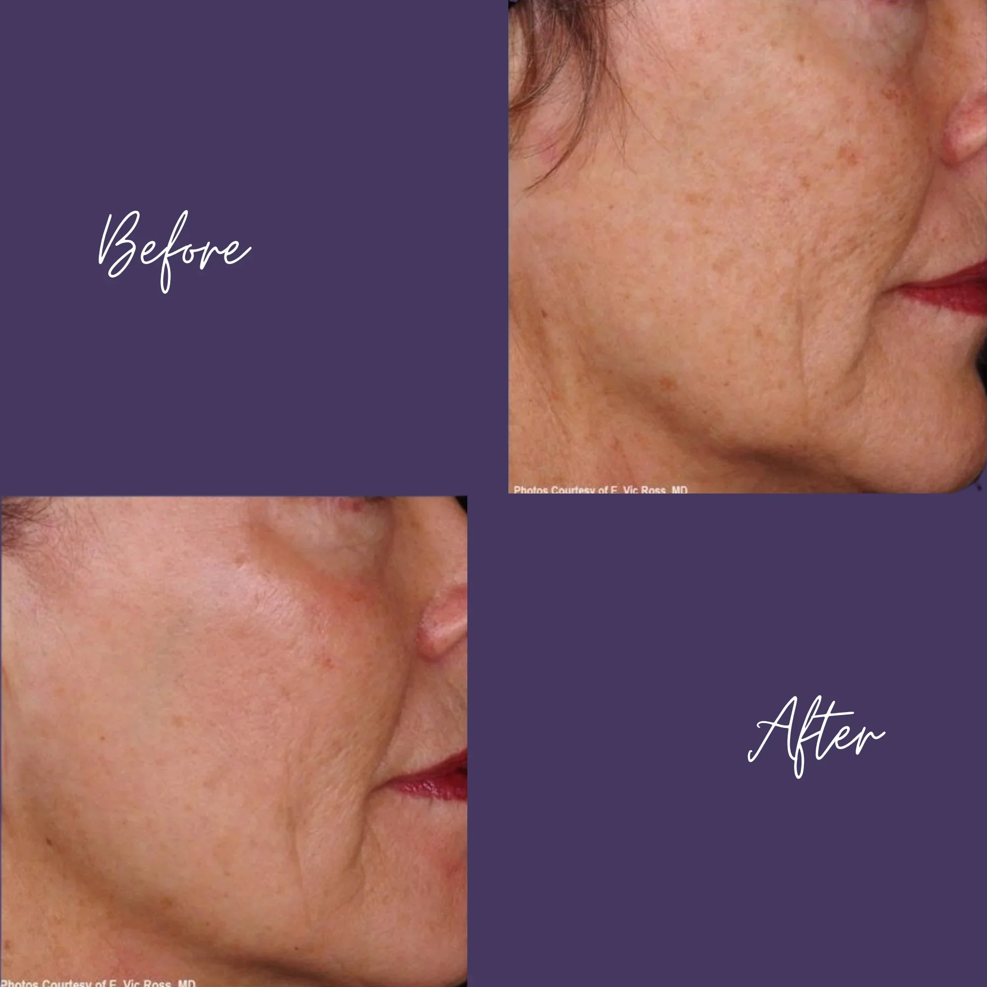 Pearl Fusion Laser Treatment + Free Secret RF Neck & Hands (Feb 1-28)
