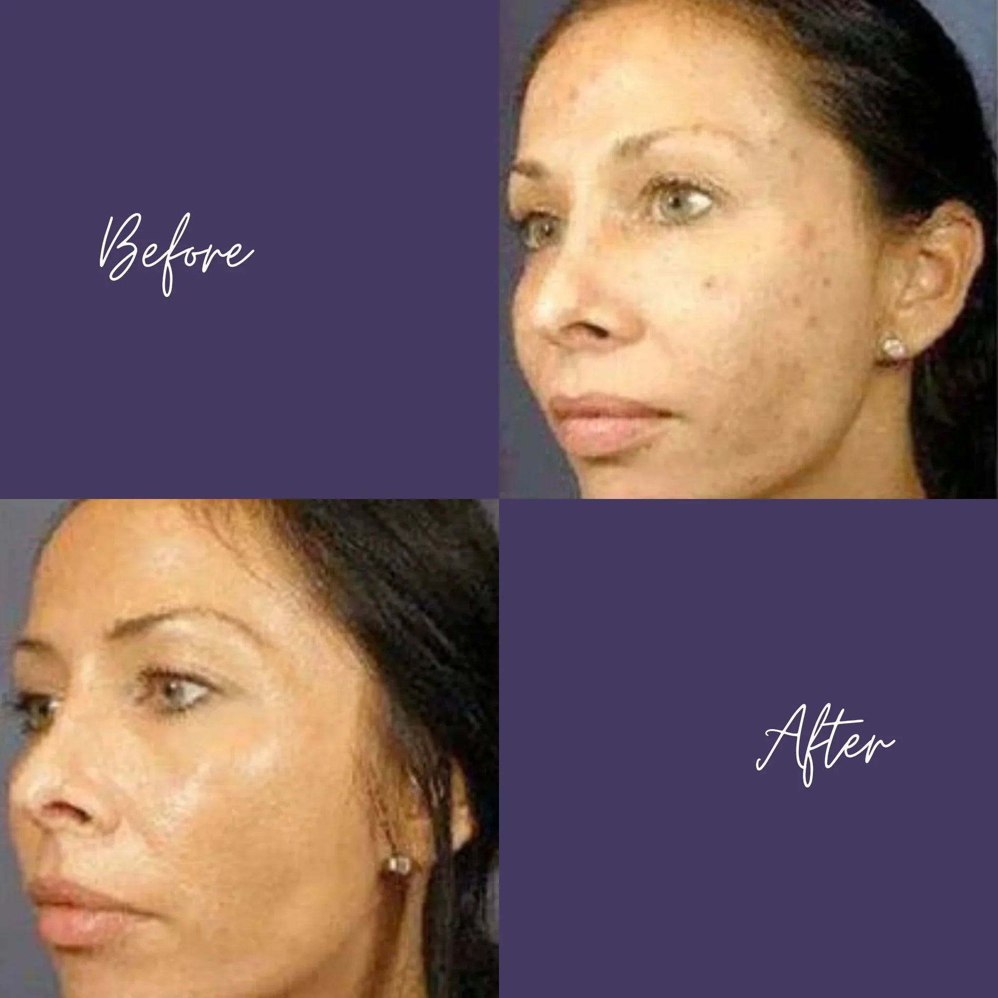 VI Peel PURIFY: Chemical Peels: Receive Free Neck Treatment (Feb 1-28)