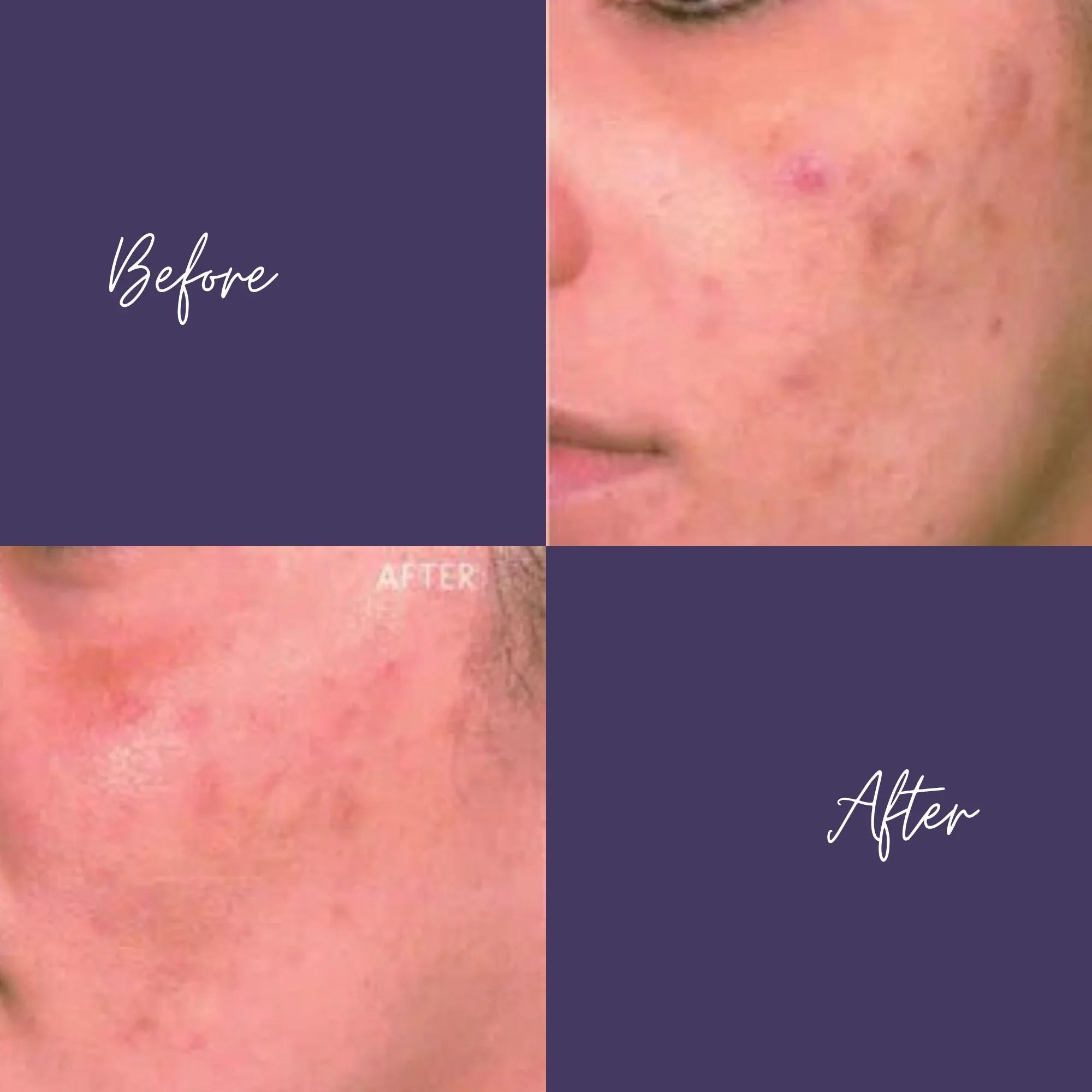VI Peel PURIFY: Chemical Peels: Receive Free Neck Treatment (Feb 1-28)