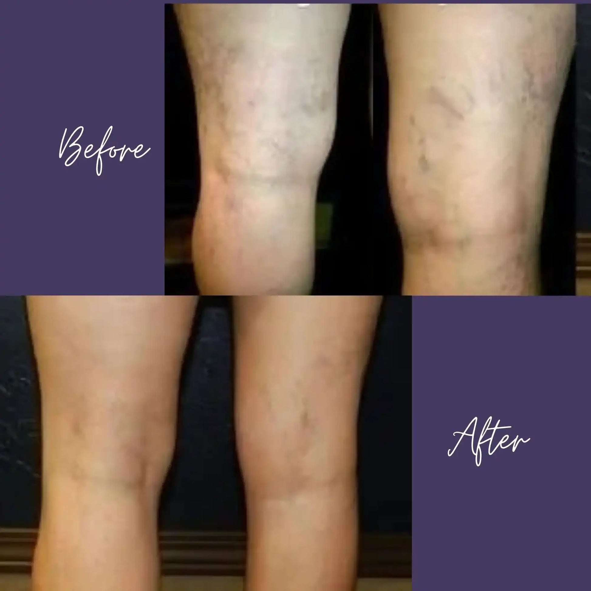 Before and after comparison of legs showing improved skin texture and reduced discoloration