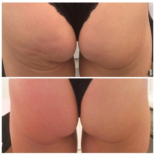 Mariposa Aesthetics & Laser Center T-Shape Body Contouring Device