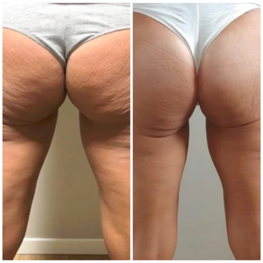 Mariposa Aesthetics & Laser Center T-Shape Body Contouring Device