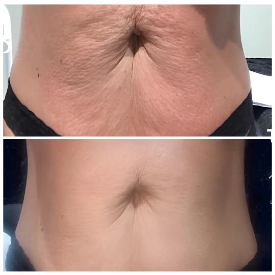 Mariposa Aesthetics & Laser Center T-Shape Body Contouring Device