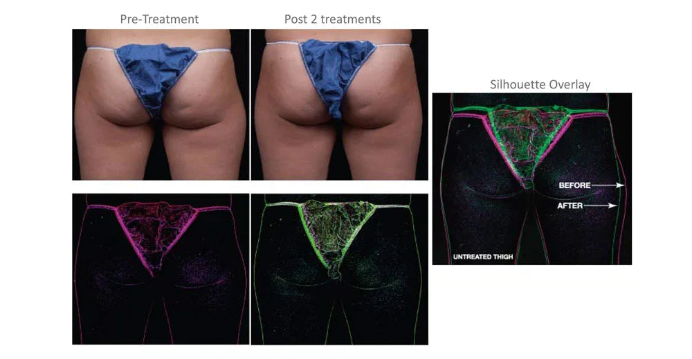 Mariposa Aesthetics & Laser Center truSculpt iD: Effective Body Contouring Solution