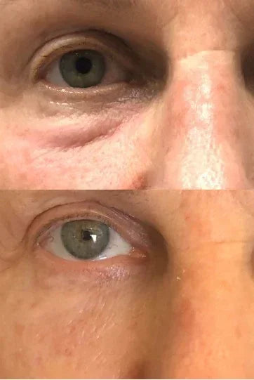 Mariposa Aesthetics & Laser Center Agnes RF Device for Precise Skin Treatments