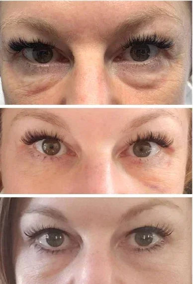 Mariposa Aesthetics & Laser Center Agnes RF Device for Precise Skin Treatments