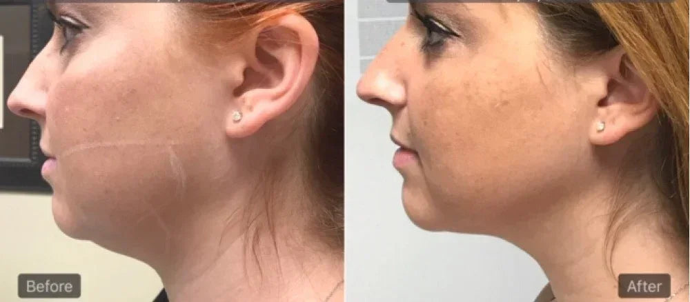 Mariposa Aesthetics & Laser Center Agnes RF Device for Precise Skin Treatments