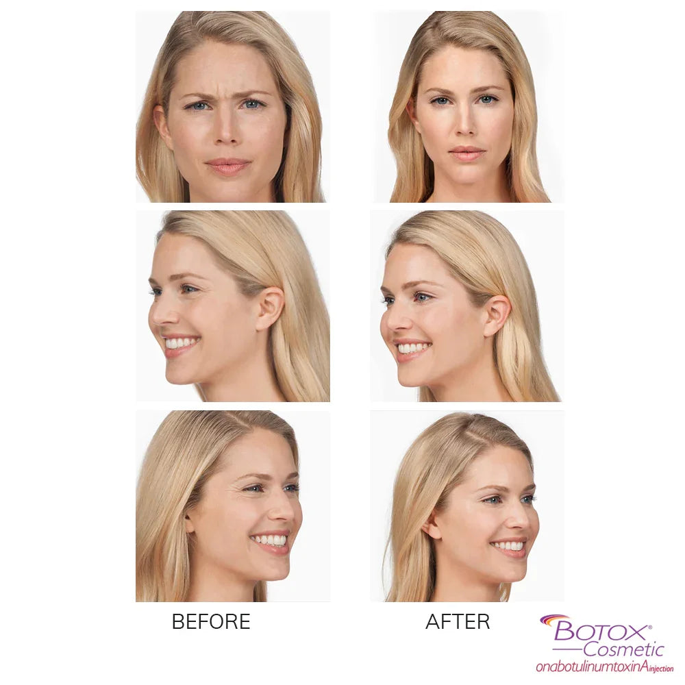 Mariposa Aesthetics & Laser Center Botox Neurotoxin Wrinkle Relaxer