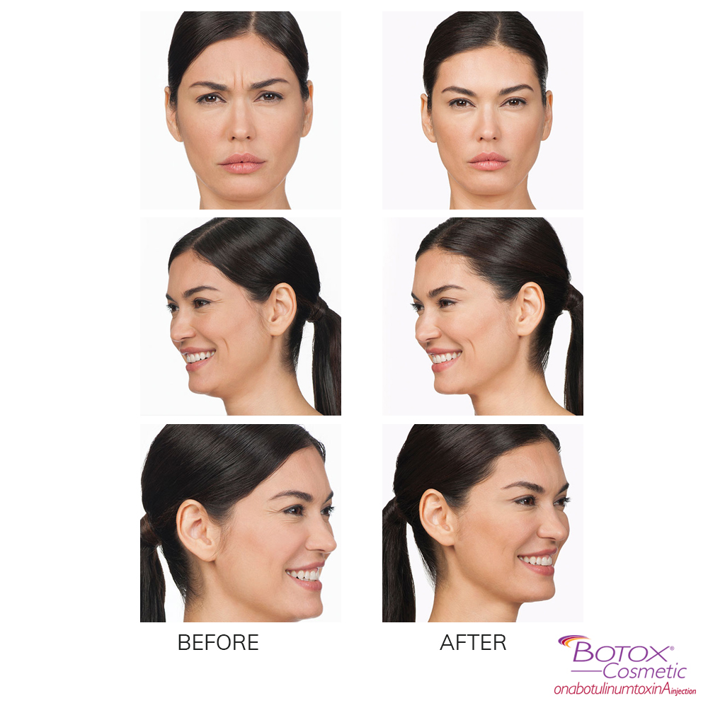 Mariposa Aesthetics & Laser Center Botox Neurotoxin Wrinkle Relaxer