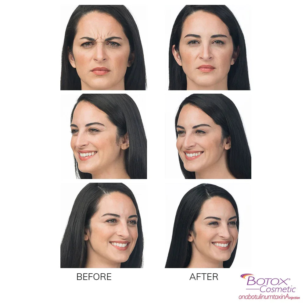 Mariposa Aesthetics & Laser Center Botox Neurotoxin Wrinkle Relaxer
