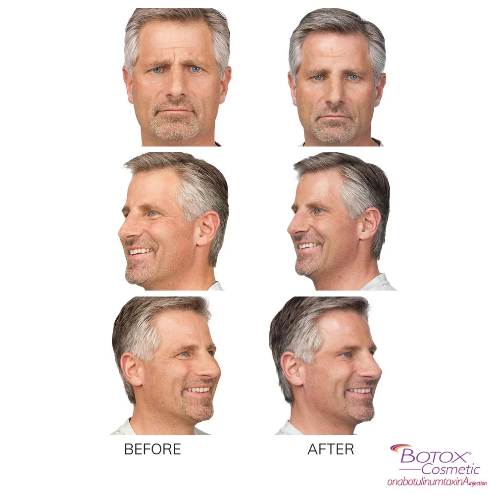 Mariposa Aesthetics & Laser Center Botox Neurotoxin Wrinkle Relaxer