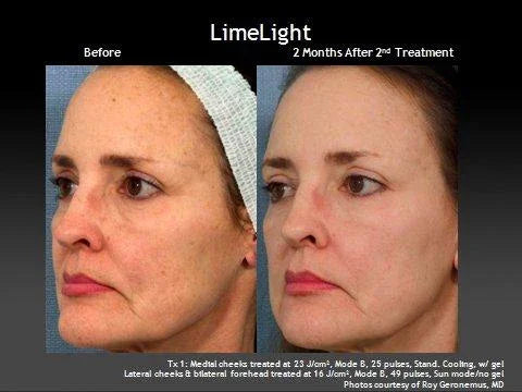 Mariposa Aesthetics & Laser Center LimeLight IPL Photofacial by Cutera®